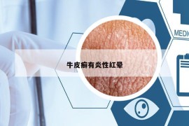 牛皮癬有炎性紅暈
