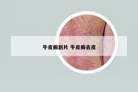 牛皮癬刮片 牛皮癬去皮