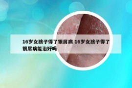 16歲女孩子得了銀屑病 16歲女孩子得了銀屑病能治好嗎