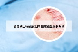 銀屑病生物制劑乙肝 銀屑病生物制劑吧