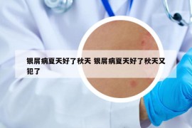 銀屑病夏天好了秋天 銀屑病夏天好了秋天又犯了