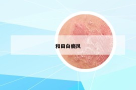 和田白癜風(fēng)