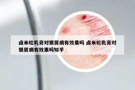 鹵米松乳膏對銀屑病有效果嗎 鹵米松乳膏對銀屑病有效果嗎知乎