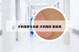沙利度胺牛皮癬 沙利度胺 銀屑病