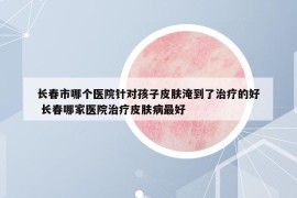 長(zhǎng)春市哪個(gè)醫(yī)院針對(duì)孩子皮膚淹到了治療的好 長(zhǎng)春哪家醫(yī)院治療皮膚病最好