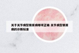 關(guān)于關(guān)節(jié)病型銀屑病哪項正確 關(guān)節(jié)病型銀屑病的診斷標準