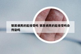 銀屑病男的能接受嗎 銀屑病男的能接受嗎會(huì)傳染嗎