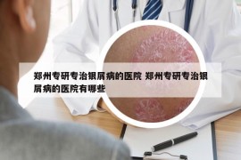 鄭州專研專治銀屑病的醫(yī)院 鄭州專研專治銀屑病的醫(yī)院有哪些