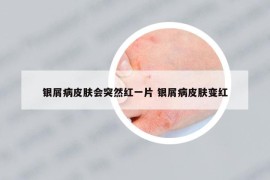 銀屑病皮膚會(huì)突然紅一片 銀屑病皮膚變紅