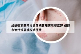成都哪家醫(yī)院治銀屑病正規(guī)醫(yī)院哪家好 成都市治療銀屑病權(quán)威醫(yī)院