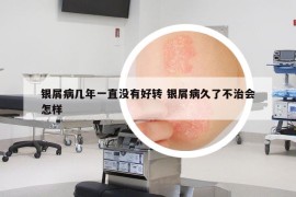 銀屑病幾年一直沒有好轉 銀屑病久了不治會怎樣