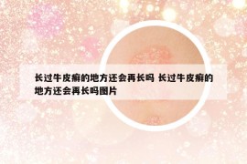 長過牛皮癬的地方還會再長嗎 長過牛皮癬的地方還會再長嗎圖片