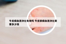 牛皮癬血液凈化有用嗎 牛皮膚癬血液凈化需要多少錢