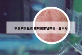 銀屑病很輕微 銀屑病很輕微但一直不好