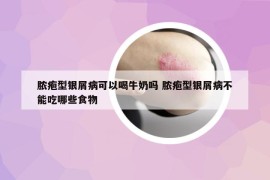膿皰型銀屑病可以喝牛奶嗎 膿皰型銀屑病不能吃哪些食物
