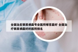 全國(guó)治愈銀屑病最專(zhuān)業(yè)醫(yī)院哪家最好 全國(guó)治療銀屑病最好的醫(yī)院排名