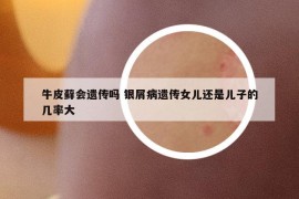 牛皮蘚會(huì)遺傳嗎 銀屑病遺傳女兒還是兒子的幾率大