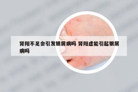 腎陽不足會引發(fā)銀屑病嗎 腎陽虛能引起銀屑病嗎