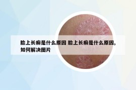 臉上長癬是什么原因 臉上長癬是什么原因,如何解決圖片