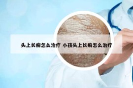 頭上長癬怎么治療 小孩頭上長癬怎么治療