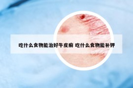 吃什么食物能治好牛皮癬 吃什么食物能補鉀