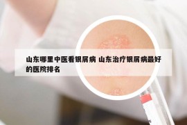 山東哪里中醫(yī)看銀屑病 山東治療銀屑病最好的醫(yī)院排名