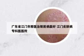 廣東省江門(mén)市那醫(yī)治銀屑病最好 江門(mén)皮膚病?？漆t(yī)醫(yī)院