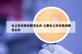 頭上長(zhǎng)白色的癬怎么辦 兒童頭上長(zhǎng)白色的癬怎么辦