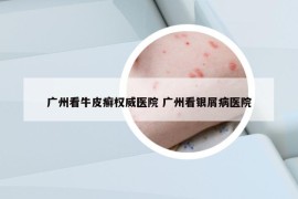 廣州看牛皮癬權(quán)威醫(yī)院 廣州看銀屑病醫(yī)院