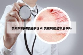 類銀屑病和銀屑病區(qū)別 類銀屑病是銀屑病嗎