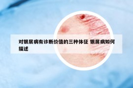 對銀屑病有診斷價值的三種體征 銀屑病如何描述