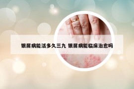銀屑病能活多久三九 銀屑病能臨床治愈嗎
