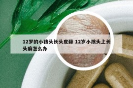 12歲的小孩頭長頭皮蘚 12歲小孩頭上長頭癬怎么辦