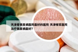 天津看銀屑病醫(yī)院最好的醫(yī)院 天津哪家醫(yī)院治療銀屑病最好?