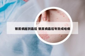 銀屑病越到最后 銀屑病最后導(dǎo)致成啥病