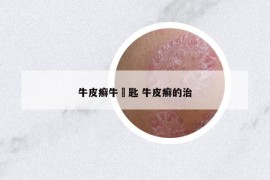 牛皮癬牛鈅匙 牛皮癬的治
