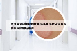 急性點滴狀銀屑病皮膚鏡結果 急性點滴狀銀屑病皮膚鏡結果圖