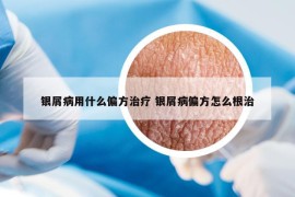 銀屑病用什么偏方治療 銀屑病偏方怎么根治