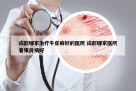 成都哪家治療牛皮癬好的醫(yī)院 成都哪家醫(yī)院看銀屑病好