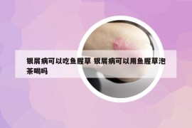銀屑病可以吃魚腥草 銀屑病可以用魚腥草泡茶喝嗎