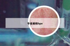 牛皮癬和hpv