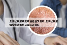 點(diǎn)滴狀銀屑病皮疹消退后又發(fā)紅 點(diǎn)滴狀銀屑病皮疹消退后又發(fā)紅正常嗎