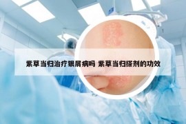 紫草當(dāng)歸治療銀屑病嗎 紫草當(dāng)歸搽劑的功效