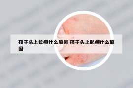 孩子頭上長癬什么原因 孩子頭上起癬什么原因