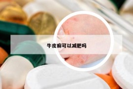 牛皮癬可以減肥嗎