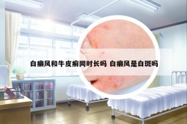 白癩風和牛皮癬同時長嗎 白癩風是白斑嗎