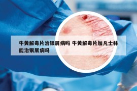 牛黃解毒片治銀屑病嗎 牛黃解毒片加凡士林能治銀屑病嗎
