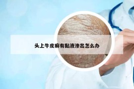 頭上牛皮癬有黏液滲出怎么辦