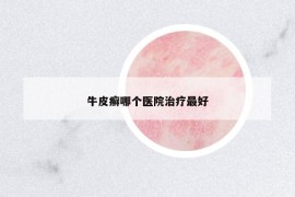 牛皮癬哪個醫(yī)院治療最好