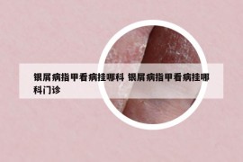 銀屑病指甲看病掛哪科 銀屑病指甲看病掛哪科門診